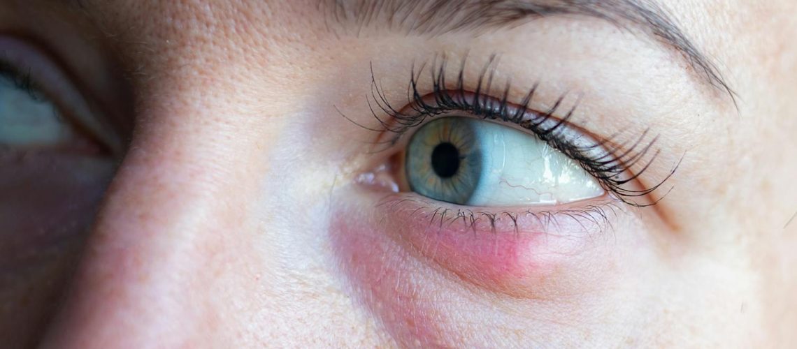 Gonflement sous l'œil : quelles causes ? Que faire ?